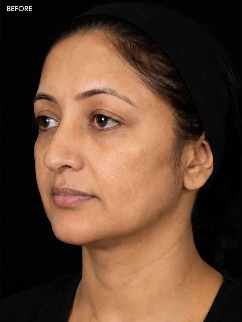 After — babyGLOW™ Skin Booster